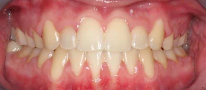 Adult Teen - Anterior Crossbite Under Bite Before After Smile Results