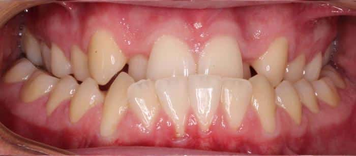Adult Teen - Anterior Crossbite Under Bite Before After Smile Results