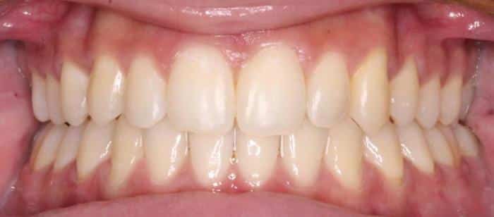 Adult Teen Crowding - Invisalign Before After Smile Results