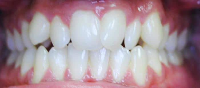 Adult Teen Crowding Invisalign Before After Smile Results