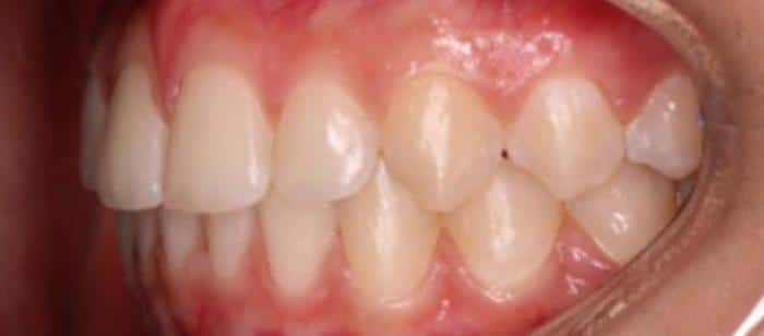 Adult Teen Flared Teeth Invisalign Before After Results