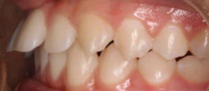 Adult Teen Flared Teeth Invisalign Before After Results