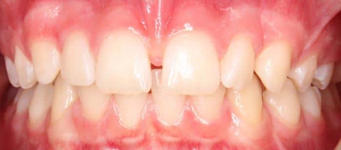 Adult Teen - Spacing Before After Smile Results