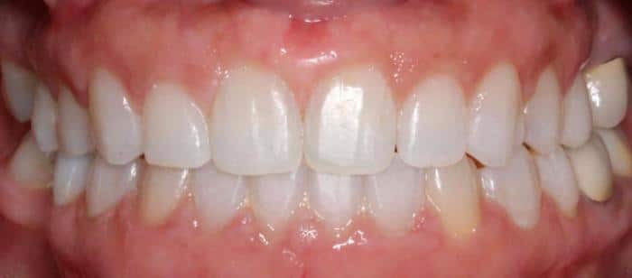 Adult Teen - Spacing and Crossbite Before After Smile Results
