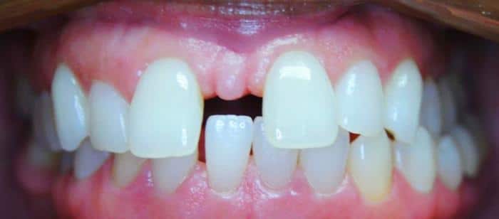 Adult Teen - Spacing and Crossbite Before After Results