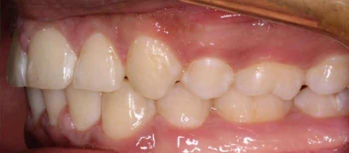 Adult Teen - Tooth Extractions Before After Results