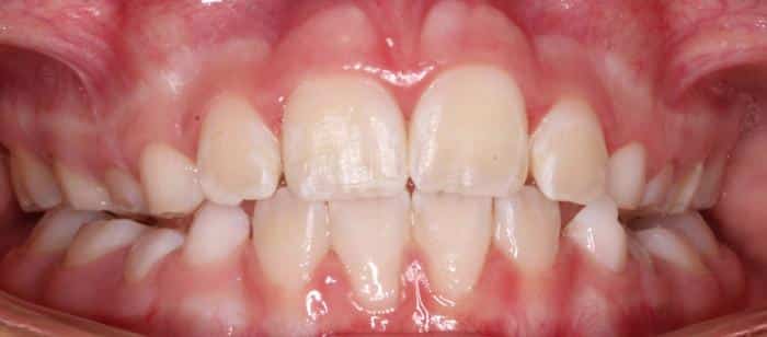 Treatment on Children Before After Smile Treatment
