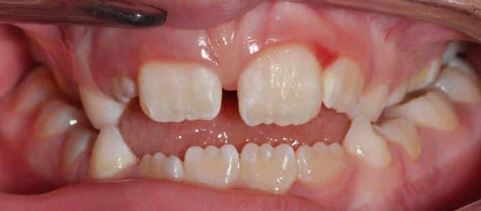 Child Treatment - Before After Smile Results