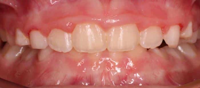 Treatment on children Making space for upper four front teeth before after smile results