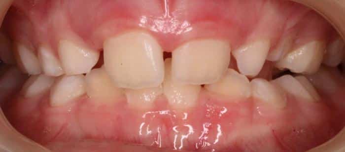 Treatment on children making space for upper four front teeth before after results