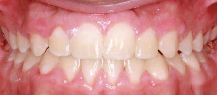 Anterior Crossbite Under Bite After Smile Results Teenager