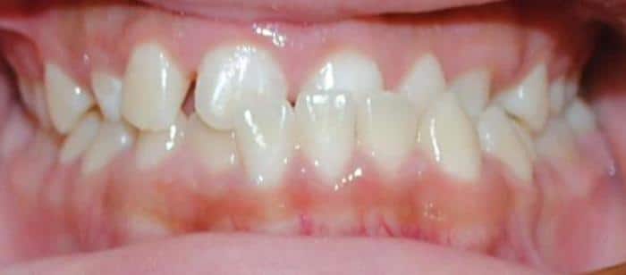 Anterior Crossbite Under Bite Before and After Smile Results