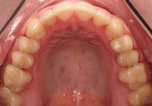 adult teen expansion before after smile results