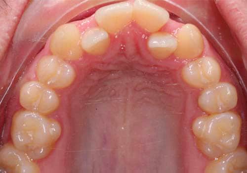 adult teen expansion before after smile results