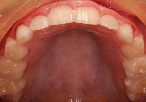 phase 1 before after smile results