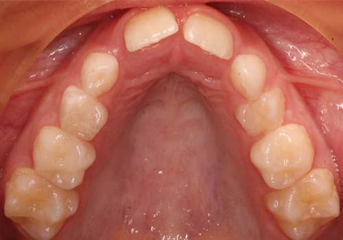 Phase 1 Expansion Before After Smile Results